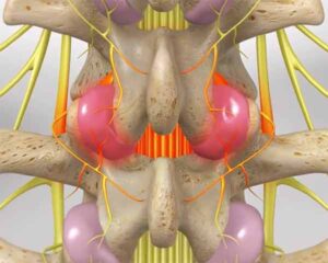 illustration of medial branch inflamed. Shoreside interventional Pain, Sarasota, FL