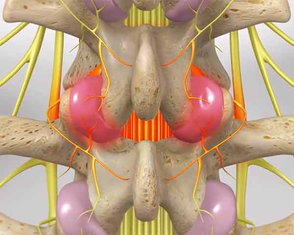 illustration of medial branch inflamed. Shoreside interventional Pain, Sarasota, FL