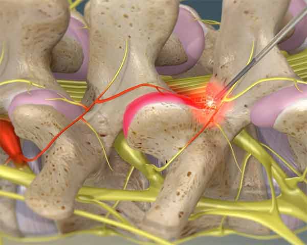 pain management clinic that uses radiofrequency nerve ablation to treat painful facet joints.