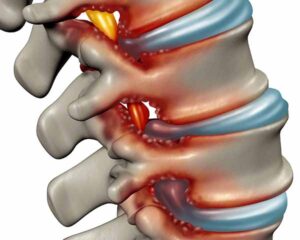 Illustration of spinal stenosis in spine. Shoreside Interventional Pain in Sarasota, FL.
