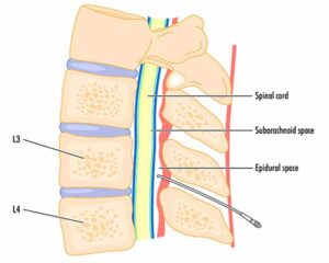 Illustration showing epidural injection location. Shoreside Interventional Pain in Sarasota, Florida.