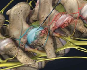 Pain management for facet joint. Facet Joint injection.