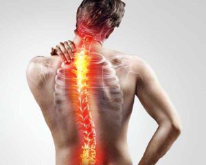 Failed back surgery treatment at Shoreside interventional Pain in Sarasota Florida.