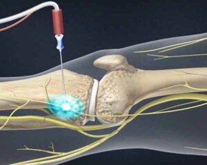 Pain management for knee pain in Sarasota, FL.