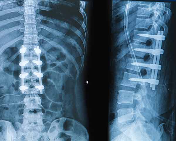 Hardware injection in your back x-ray. Shoreside Interventional Pain a sarasota pain management clinic.