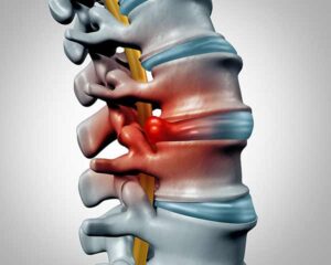 Illustration of herniated disk in spine. Shoreside Interventional Pain, Sarasota, FL.