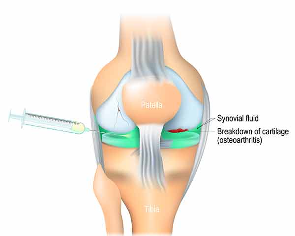 Illustration of a knee joint being injected for treatment at Shoreside Interventional Pain in Sarasota, FL.