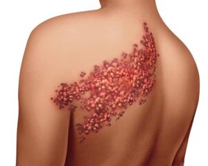 Illustration of shingles on skin. Shoreside Pain Treatment, Sarasota, FL.