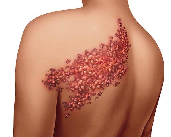 Illustration of shingles on skin. Shoreside Pain Treatment, Sarasota, FL.