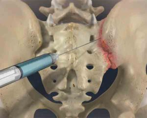 Illustration of a sacroiliac injection for pain management in Sarasota, FL.
