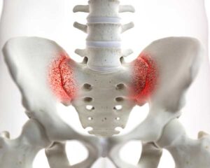 Illustration of Sacroiliac joint pain. Shoreside Interventional Pain in Sarasota, Florida