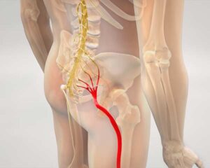 Illustration of sciatic nerve from hip to leg. Shoreside Interventional Pain in Sarasota, FL.