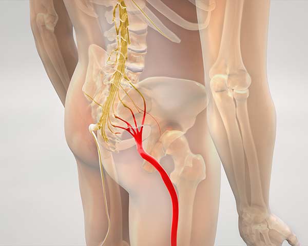 Illustration of sciatic nerve from hip to leg. Shoreside Interventional Pain in Sarasota, FL.