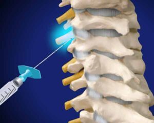 Injections for pain management, selective nerve root block illustration.