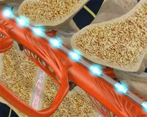 Illustration of spinal cord stimulation for pain management in Sarasota, FL.