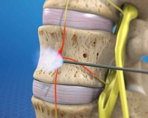 Pain management Sarasota, Florida.