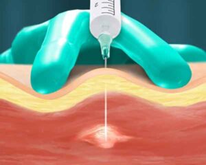 Pain management with trigger point injections illustration. Shoresline Interventional Pain, Sarasota, FL.